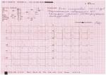Ранняя реполяризация желудочков? фото 1