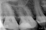 Болит зуб после лечения фото 2