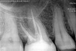 Болит зуб после лечения фото 1