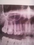 Не выясненная боль в пролеченных зубах фото 2