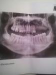 Не выясненная боль в пролеченных зубах фото 1