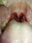 Воспаленные миндалины и красное горло фото 2