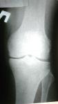 Боли в коленях, помогите расшифровать диагноз фото 1