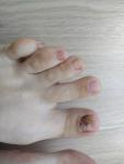 Синяки под ногтями, олиохолиз без внешних травм фото 2