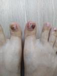 Синяки под ногтями, олиохолиз без внешних травм фото 1