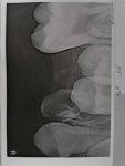 Рентген снимок корня зуба фото 1
