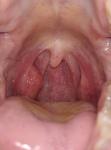 Увеличена миндалина, красные пятна на стенке горла и дужек фото 1