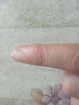 Мелкие прозрачные высыпания на пальцах рук фото 1