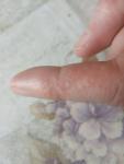 Мелкие прозрачные высыпания на пальцах рук фото 2