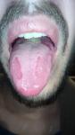 Язвы на боковой части языка, воспален лимфоузел на шее, жжение фото 1