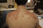Атопический дерматит пятна на спине фото 1