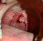 Красный отек на язычке в горле (фото прилагается) фото 1