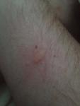 Болячка на руке похожая на укус комара фото 1