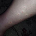 Красные высыпания на коже ног и рук, похожие на комариные фото 1