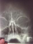 Рентген пазух носа, искривление носовой перегородки фото 2
