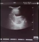 Отсутсвие месячных после медикаментозного аборта фото 1