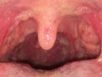 Шишки в горле, опухшие миндалины фото 2