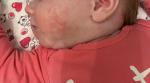 Сыпь на лице у месячного ребёнка фото 2