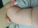Атопический дерматит у 3-месячного ребенкао фото 1