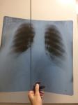 Ренген лёгких, расшифровка, диагноз фото 2