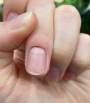 Повреждение ногтя и кожи фото 1