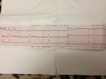 Расшифровка экг, жалобы на боль в груди фото 3