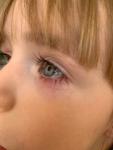 Воспаление глаза у ребёнка 4 лет фото 4