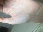 Плотная шишка на вене руки (ладонь), болит при надавливании фото 3