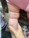 Сыпь у ребенка атонический дерматит аллергия фото 1