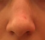 Красное пятно на кончике носа с сосудом фото 3