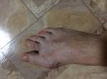 Боли после операции косточки большого пальца фото 1