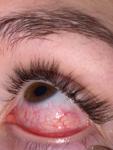 Болит при моргании и покраснел глаз слева фото 1