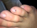 Пятно на ногте пальца ноги меланома или гематома? фото 5