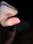 Грибок ногтя на руке фото 4