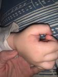 Мелкая сыпь на ручках у ребёнка 2 года фото 4