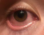 Красные белки глаз, сухость фото 2