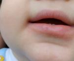 Припухлость с покраснением нижней губы у ребенка фото 2