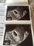 Нет эмбриона и СБ на 7 акушерской недели фото 2