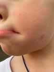 Аллергия у ребенка от солнца фото 1
