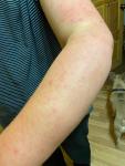 Красная кожа на руке с лимфостазом фото 3