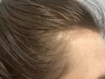 Выпадение волос на определенных участках фото 2