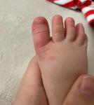 Опухший и в пятнах большой палец на ноге у ребенка фото 1