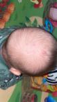 Сыпь на голове у младенца 5,5 месяцев фото 1