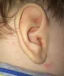 Зуд уха, сужение слухового прохода фото 1