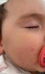 Сыпь на лице у ребенка 9 месяцев фото 1