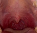 Боль в горле после тонзиллита, странный цвет горла фото 2
