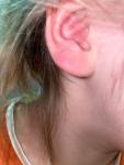 Гнойные шишки в ушах, пятна похожие на РАНы, облачите кожа фото 1