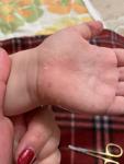 Облазит кожа рук и ног у ребенка фото 2