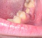 Боль в десне спустя неделю после удаления зуба фото 1