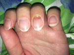 Заболевания ногтей, отсутствие ногтя у основания фото 1